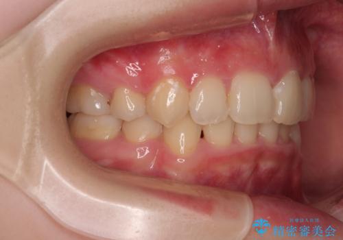 【モニター】デコボコと隠れてしまう前歯 ワイヤー装置による抜歯矯正で美しい口元にの治療後
