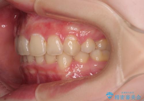 【モニター】デコボコと隠れてしまう前歯 ワイヤー装置による抜歯矯正で美しい口元にの治療後