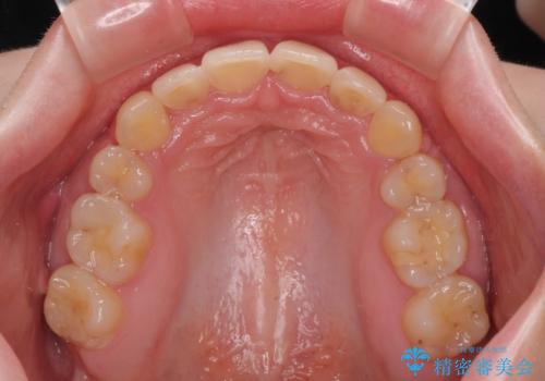 【モニター】デコボコと隠れてしまう前歯 ワイヤー装置による抜歯矯正で美しい口元にの治療後