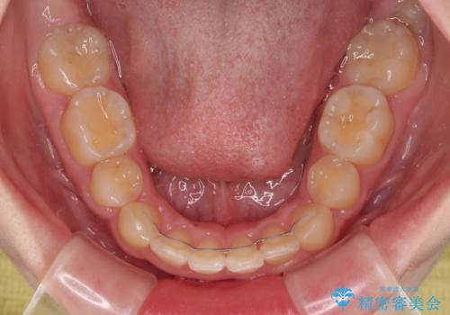 【モニター】デコボコと隠れてしまう前歯 ワイヤー装置による抜歯矯正で美しい口元にの治療後