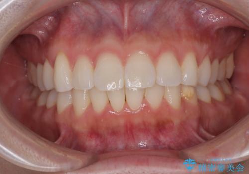 気になる前歯を短期間で治す インビザライン・モデレートでの矯正治療の治療後