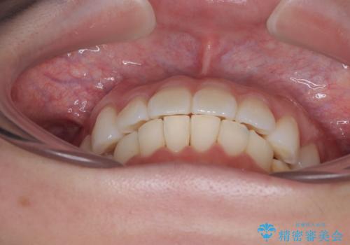 気になる前歯を短期間で治す インビザライン・モデレートでの矯正治療の治療後