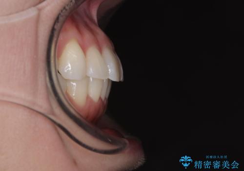 気になる前歯を短期間で治す インビザライン・モデレートでの矯正治療の治療後