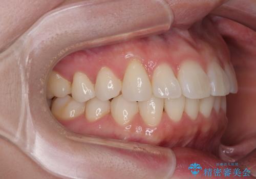 気になる前歯を短期間で治す インビザライン・モデレートでの矯正治療の治療後