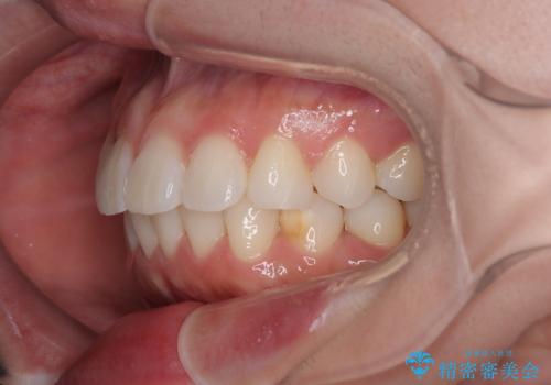 気になる前歯を短期間で治す インビザライン・モデレートでの矯正治療の治療後