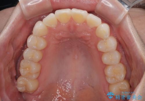 気になる前歯を短期間で治す インビザライン・モデレートでの矯正治療の治療後