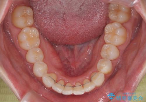 気になる前歯を短期間で治す インビザライン・モデレートでの矯正治療の治療後