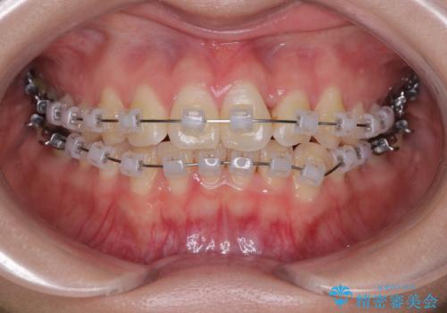 前歯のねじれ・ガタガタを10か月で改善!20代女性の矯正治療|クリアブラケットでむし歯になりにくい歯並びへ改善の治療中