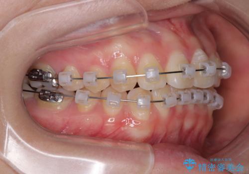 前歯のねじれ・ガタガタを10か月で改善!20代女性の矯正治療|クリアブラケットでむし歯になりにくい歯並びへ改善の治療中