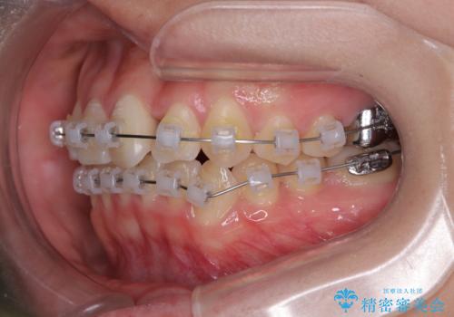 前歯のねじれ・ガタガタを10か月で改善!20代女性の矯正治療|クリアブラケットでむし歯になりにくい歯並びへ改善の治療中
