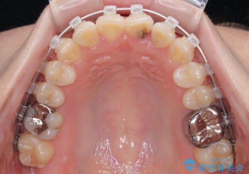 前歯のねじれ・ガタガタを10か月で改善!20代女性の矯正治療|クリアブラケットでむし歯になりにくい歯並びへ改善の治療中