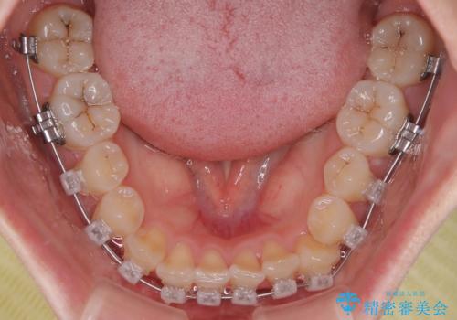 前歯のねじれ・ガタガタを10か月で改善!20代女性の矯正治療|クリアブラケットでむし歯になりにくい歯並びへ改善の治療中