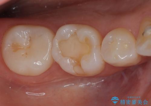 右下に虫歯ができた セラミックインレー修復の症例 治療後
