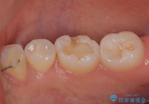右下に虫歯ができた セラミックインレー修復の治療後