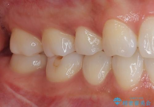 右下に虫歯ができた セラミックインレー修復の治療後