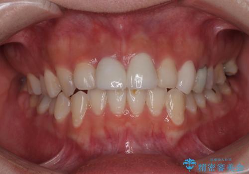 「抜歯してブリッジ」と言われた20代女性が選んだ治療とは?|たった4か月で自然な笑顔に|抜歯即時インプラント+審美補綴の症例の症例 治療後