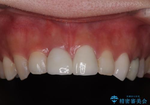 「抜歯してブリッジ」と言われた20代女性が選んだ治療とは?|たった4か月で自然な笑顔に|抜歯即時インプラント+審美補綴の症例の治療後