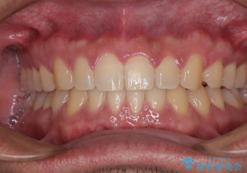 隙間だらけの歯列を治したい ワイヤー矯正での矯正治療の症例 治療後