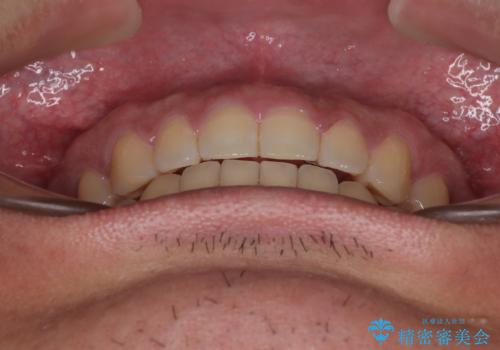隙間だらけの歯列を治したい ワイヤー矯正での矯正治療の治療後