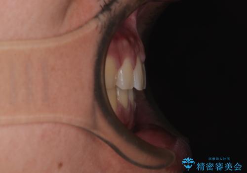 隙間だらけの歯列を治したい ワイヤー矯正での矯正治療の治療後