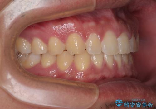 隙間だらけの歯列を治したい ワイヤー矯正での矯正治療の治療後