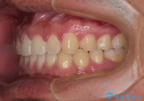 隙間だらけの歯列を治したい ワイヤー矯正での矯正治療の治療後