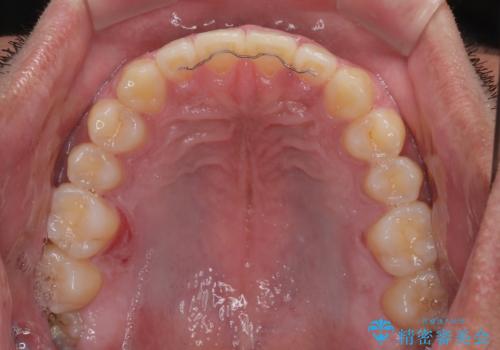 隙間だらけの歯列を治したい ワイヤー矯正での矯正治療の治療後