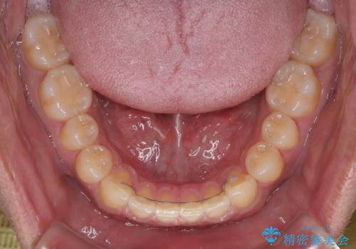 隙間だらけの歯列を治したい ワイヤー矯正での矯正治療の治療後