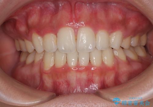 横顔の印象を改善したい ワイヤー装置での抜歯矯正の症例 治療後