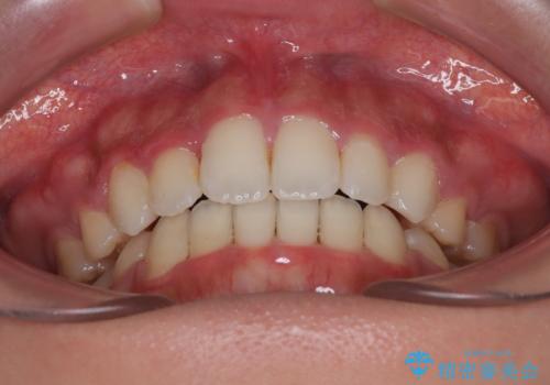 横顔の印象を改善したい ワイヤー装置での抜歯矯正の治療後