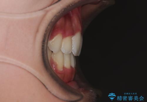 横顔の印象を改善したい ワイヤー装置での抜歯矯正の治療後