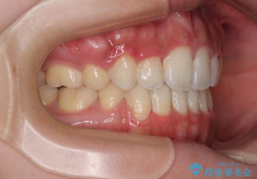 横顔の印象を改善したい ワイヤー装置での抜歯矯正の治療後