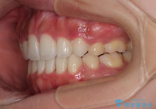 横顔の印象を改善したい ワイヤー装置での抜歯矯正の治療後