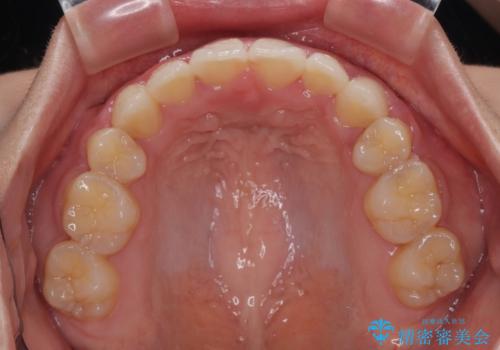 横顔の印象を改善したい ワイヤー装置での抜歯矯正の治療後