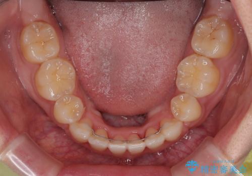 横顔の印象を改善したい ワイヤー装置での抜歯矯正の治療後