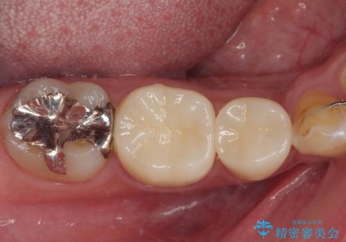 銀歯を白くしたい フルジルコニアクラウンの治療後