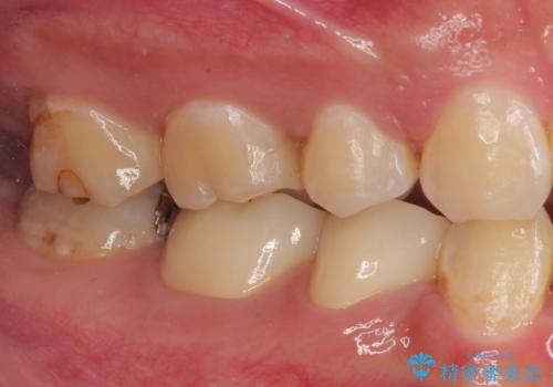 銀歯を白くしたい フルジルコニアクラウンの治療後
