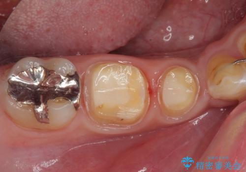 銀歯を白くしたい フルジルコニアクラウンの治療中