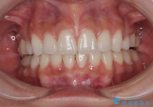 膨らんだ口元を改善する抜歯矯正 インプラント治療も同時に行う総合歯科治療の症例 治療後