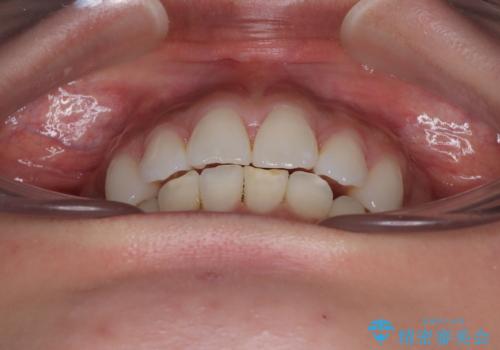 膨らんだ口元を改善する抜歯矯正 インプラント治療も同時に行う総合歯科治療の治療後