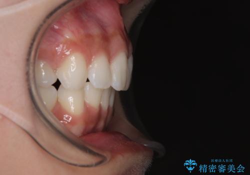 膨らんだ口元を改善する抜歯矯正 インプラント治療も同時に行う総合歯科治療の治療後