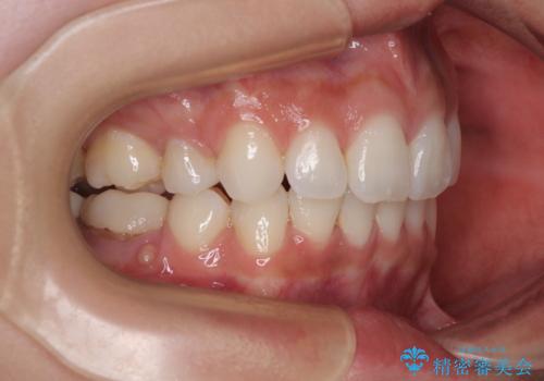 膨らんだ口元を改善する抜歯矯正 インプラント治療も同時に行う総合歯科治療の治療後