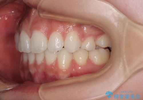 膨らんだ口元を改善する抜歯矯正 インプラント治療も同時に行う総合歯科治療の治療後