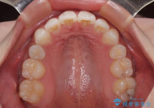 膨らんだ口元を改善する抜歯矯正 インプラント治療も同時に行う総合歯科治療の治療後