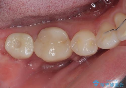 膨らんだ口元を改善する抜歯矯正 インプラント治療も同時に行う総合歯科治療の治療後