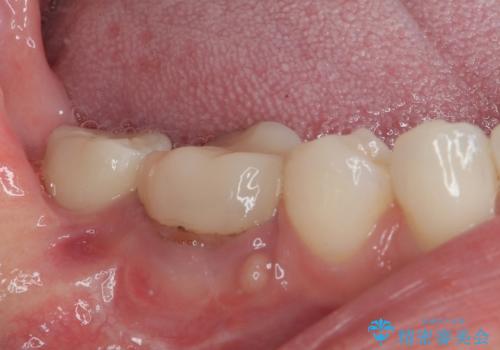 膨らんだ口元を改善する抜歯矯正 インプラント治療も同時に行う総合歯科治療の治療後