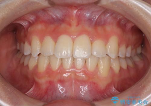 前歯のクロスバイト 裏側に隠れた歯をワイヤー装置で短期間治療の症例 治療後