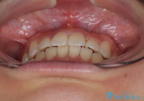 前歯のクロスバイト 裏側に隠れた歯をワイヤー装置で短期間治療の治療後