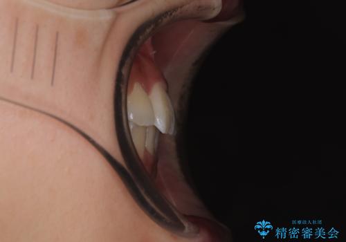 前歯のクロスバイト 裏側に隠れた歯をワイヤー装置で短期間治療の治療後