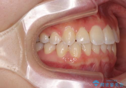 前歯のクロスバイト 裏側に隠れた歯をワイヤー装置で短期間治療の治療後